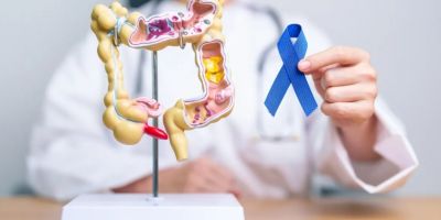 SUS inclui novo teste para rastreamento de câncer colorretal
