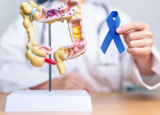 SUS inclui novo teste para rastreamento de câncer colorretal