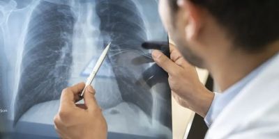 Anvisa aprova novo medicamento para câncer de pulmão avançado