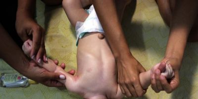 Ministério da Saúde confirma 1.113 casos de microcefalia em todo o país