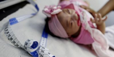 Ministério da Saúde confirma 30 novos casos de microcefalia