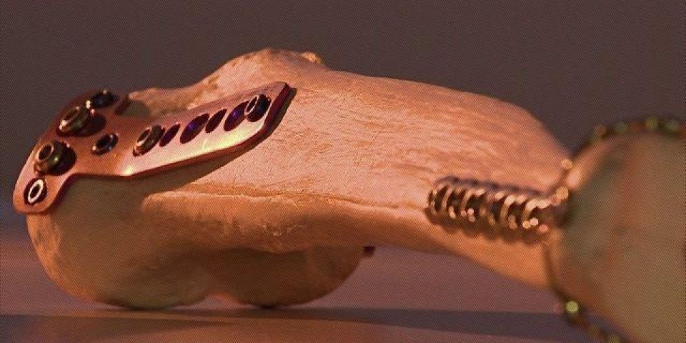 MP denuncia cinco médicos, dois advogados e seis empresários por fraude das próteses 