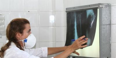 SUS vai adotar remédio para tuberculose que substitui três comprimidos por um