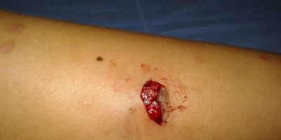 Menino de 9 anos é atacado e mordido por cachorro no bairro Santa Marta em Camaquã