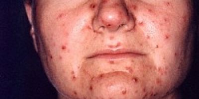 Espaço de Saúde: saiba mais sobre a doença  Herpes-zóster