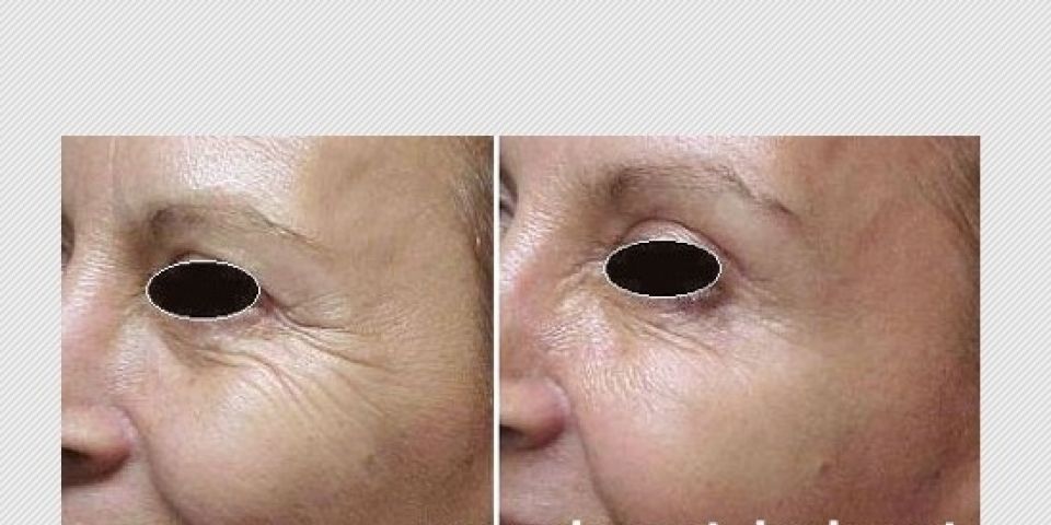 Estética: tire suas dúvidas sobre botox