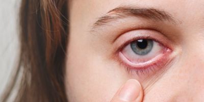 Olhos vermelhos, coçando e inchados? É conjuntivite ou blefarite?