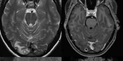 Dor de cabeça ou enxaqueca? neurologista descobre larva no cérebro de paciente