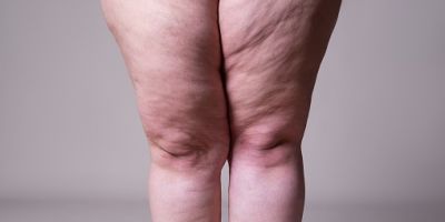  Gordura nas pernas e quadris? Médico explica o que é Lipedema