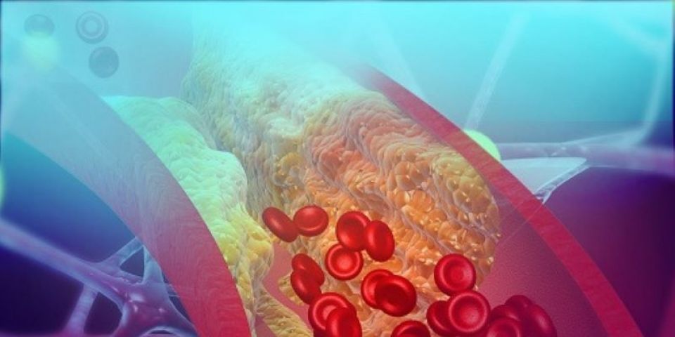 Alimentação inflamatória aumenta risco de doenças cardiovasculares