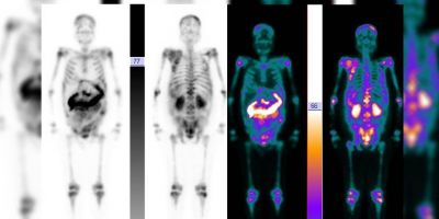 Hospital Moinhos de Vento realiza terapia considerada a nova esperança para pacientes com câncer de próstata metastático