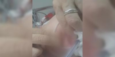 Hospital do RS apura caso de paciente encontrada com larvas na boca