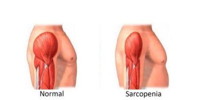 Covid-19 tem como consequência a sarcopenia