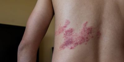 Herpes zóster: uma doença difícil, mas que tem tratamento e conta com vacina eficaz 