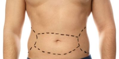 Abdominoplastia masculina: cada vez mais procurada pelos homens