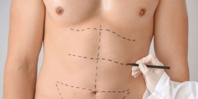 Abdominoplastia masculina é cada vez mais procurada pelos homens        