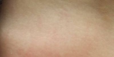 Mãe denuncia professora de provocar lesão em sua filha em Camaquã. Caso está sendo investigado