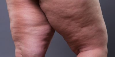 Lipedema: a doença subestimada que requer atenção e ação