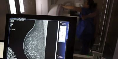 Cerca de 77 mil mulheres aguardam mamografia pelo SUS