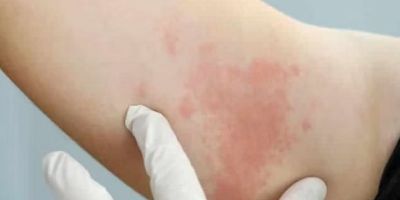 Hidradenite Supurativa: entenda o que é a doença que por ser confundida com acne pode levar anos para ser diagnosticada