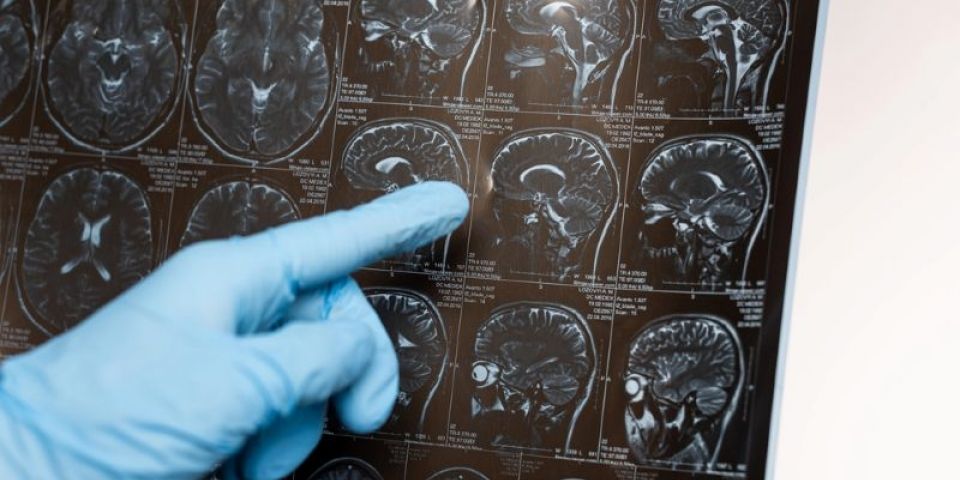 Estudo mostra que cérebro dos homens encolhe mais com envelhecimento que o das mulheres