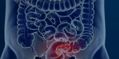 Pacientes com câncer colorretal são diagnosticados em estágio avançado