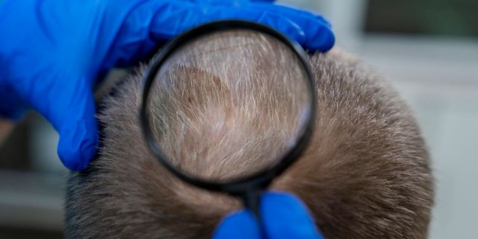 Câncer de pele pode atingir couro cabeludo: saiba como identificar e evitar que a doença passe despercebida