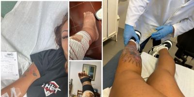 Ex-Miss Bumbum relata complicação grave após tatuagem e diz que quase precisou amputar a perna