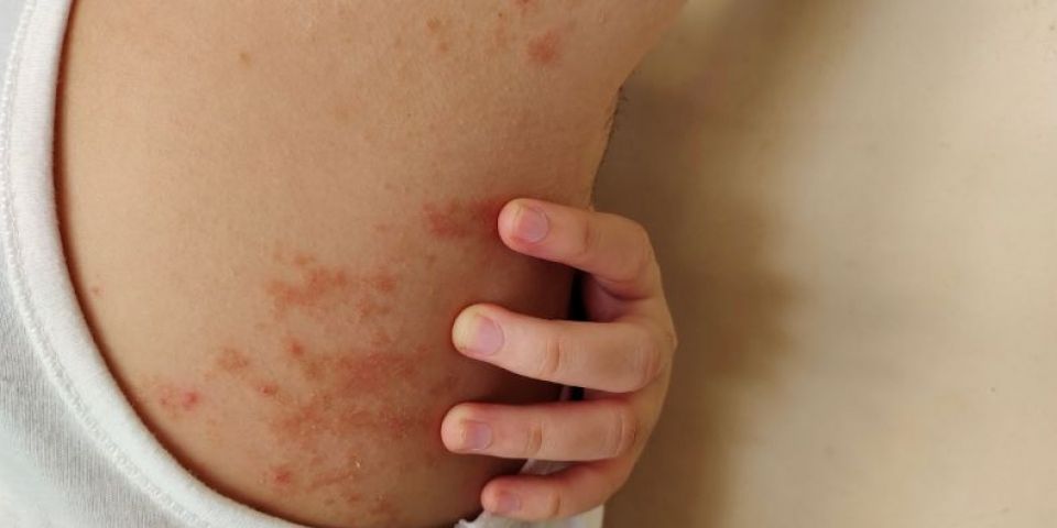 Janeiro Roxo: Hanseníase segue em circulação no país e reforça alerta para diagnóstico precoce
