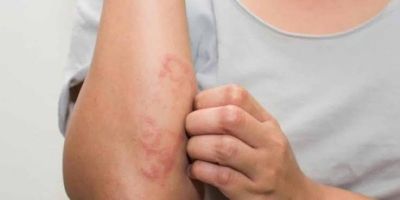 Janeiro Roxo: Brasil é o segundo país com mais casos de hanseníase e especialista alerta sobre sintomas 