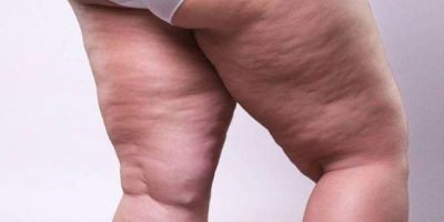 Lipedema e linfedema exigem diagnósticos distintos e atenção médica especializada, alerta cirurgião vascular