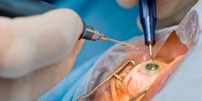 Lula faz cirurgia de catarata; entenda a doença e o procedimento