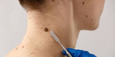 40% dos casos de câncer no mundo poderiam ser evitados, revela novo estudo da OMS