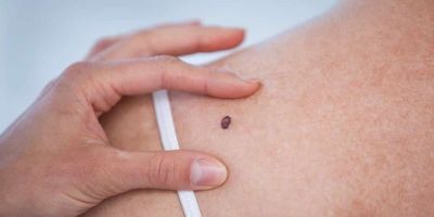 Câncer de pele atinge 30% dos diagnósticos do país, saiba sobre os cuidados à prevenção