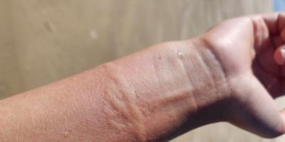 Cuidados com água-viva e outros animais marinhos exigem atenção redobrada à saúde da pele