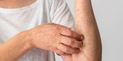 Pele x tratamentos oncológicos: como aliviar sintomas como ressecamento e coceira