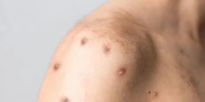 RS registra primeiro caso de mpox em 2026 e reforça importância da prevenção