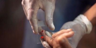 SUS começa a usar novo tratamento contra a malária em crianças